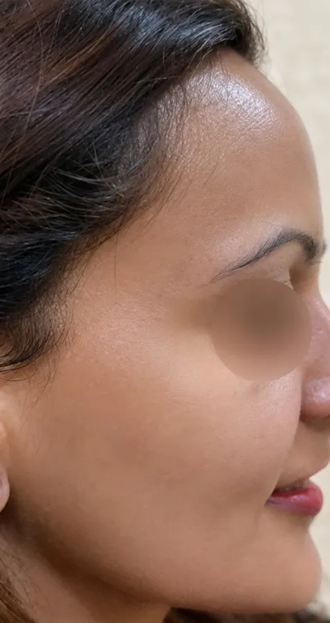 After Medifacial / Skin Resurfacing