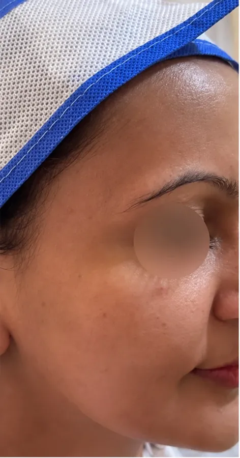 Before Medifacial / Skin Resurfacing