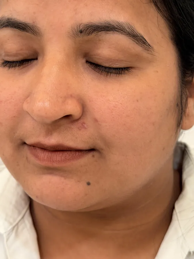 After Mole Removal