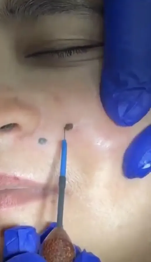 Before Mole Removal